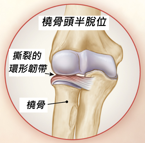 橈骨頭端脫位