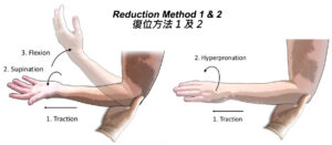 保母肘處理方法