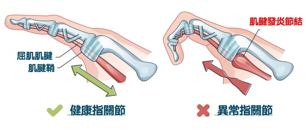 手指屈肌腱狹窄性腱鞘炎